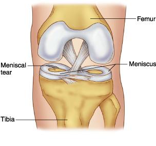 Meniscal Tear Illustrated